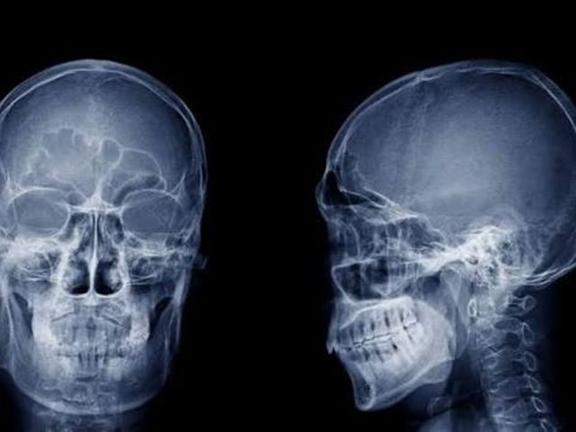 X-Ray